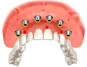 illustration-of-implant-bridge-six