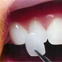 Photo of a porcelain veneer held up to a natural tooth
