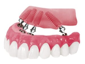 An illustration of an All-on-4 implant denture being placed on four implants in the upper jaw.