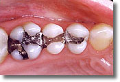 A top view of four teeth in a row. Three are filled with mercury amalgam.