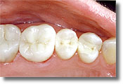 A row of three teeth with metal-free composite fillings, which are indistinguishable from natural tooth.