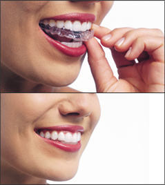 A set of two images showing a woman inserting a clear plastic Invisalign aligner over her upper teeth. She is smiling and her teeth are white.