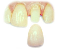 An upper row of front teeth, one of which is prepared for a same-day crown. The porcelain crown is next to the prepared tooth.