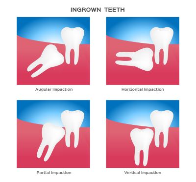 This image is an illustration with four panels, each showing a type of impacted wisdom tooth. In order from upper left to lower right, the panels show: 1. augular impaction, 2. horizontal impaction, 3. partial impaction, and 4. vertical impaction. In each image, the wisdom tooth has too little room to emerge and is pressing on the adjacent tooth.